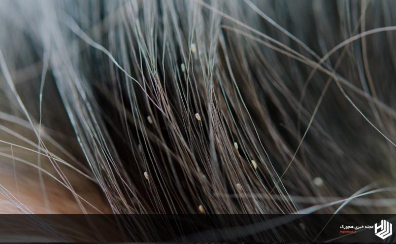 درمان شپش سر با شامپو