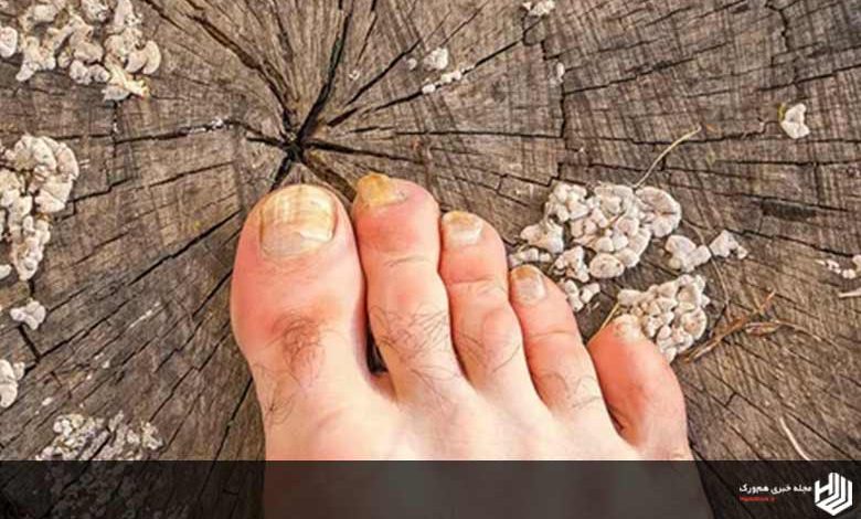 قوی ترین پماد ضد قارچ ناخن