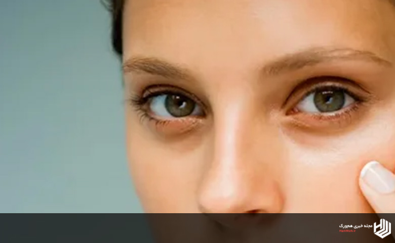 علائم و نشانه های گودی زیر چشم