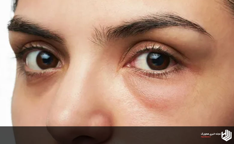سیاهی یا گودی زیر چشم چیست؟